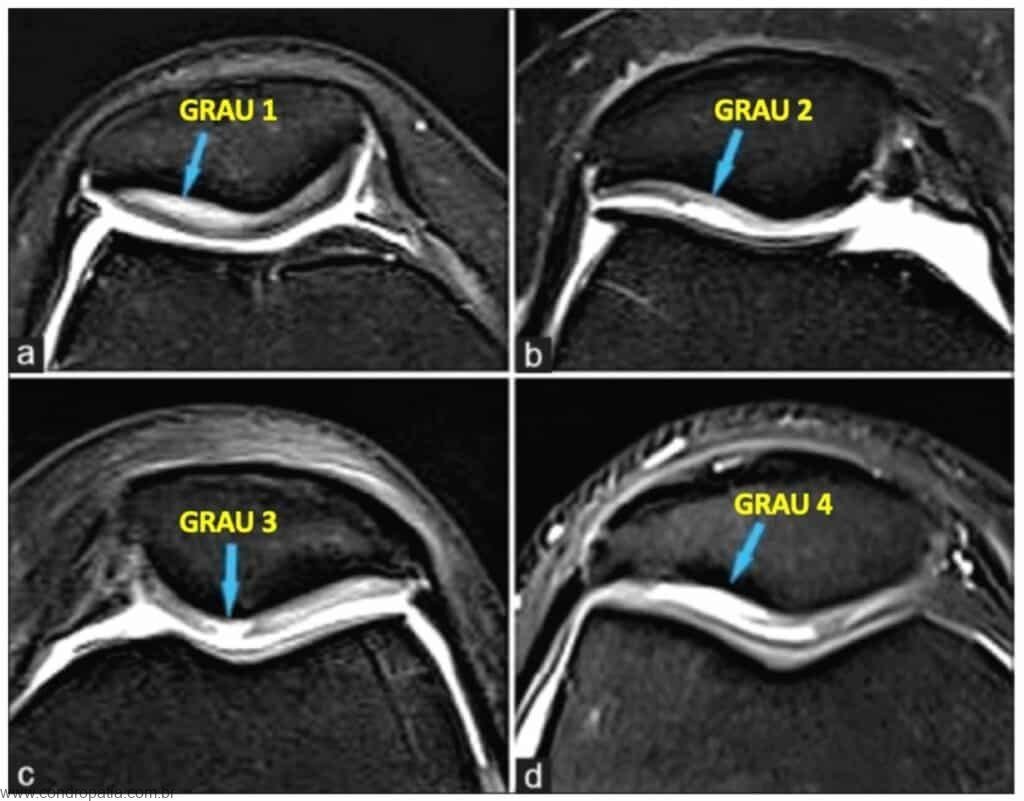 Condromalácia ou condropatia patelar o que é Ortopedista